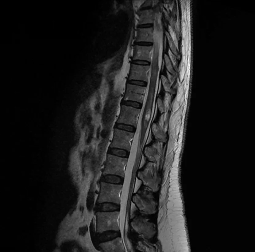 Neurochirurgie de la moelle épinière 5 Cavernome medullaire