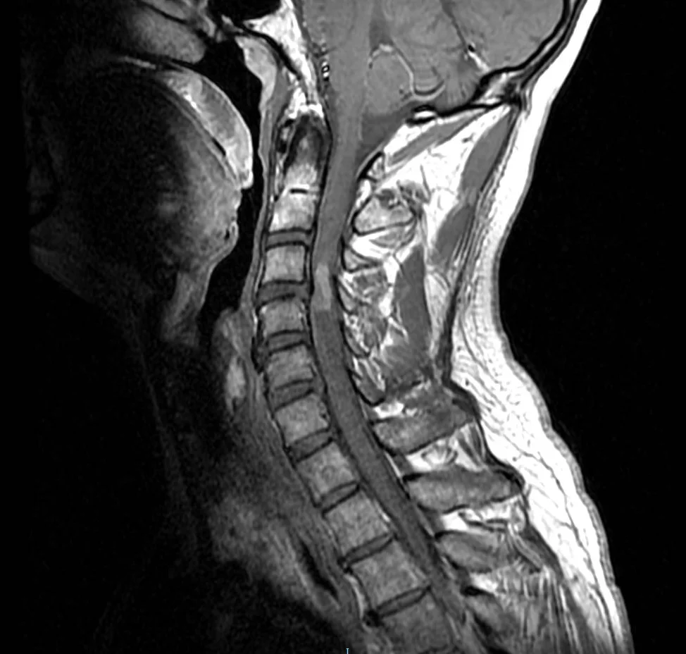 Neurochirurgie de la moelle épinière 4 Ependymome medullaire