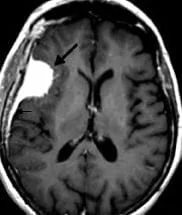 Les Méningiomes 5 Exemple de meningiome frontal droit en IRM
