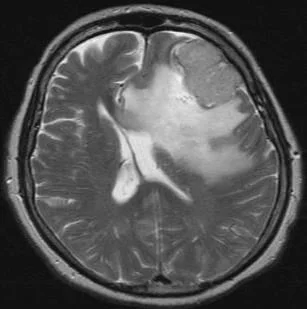 Les Méningiomes 4 Exemple de meningiome frontal gauche avec oedeme