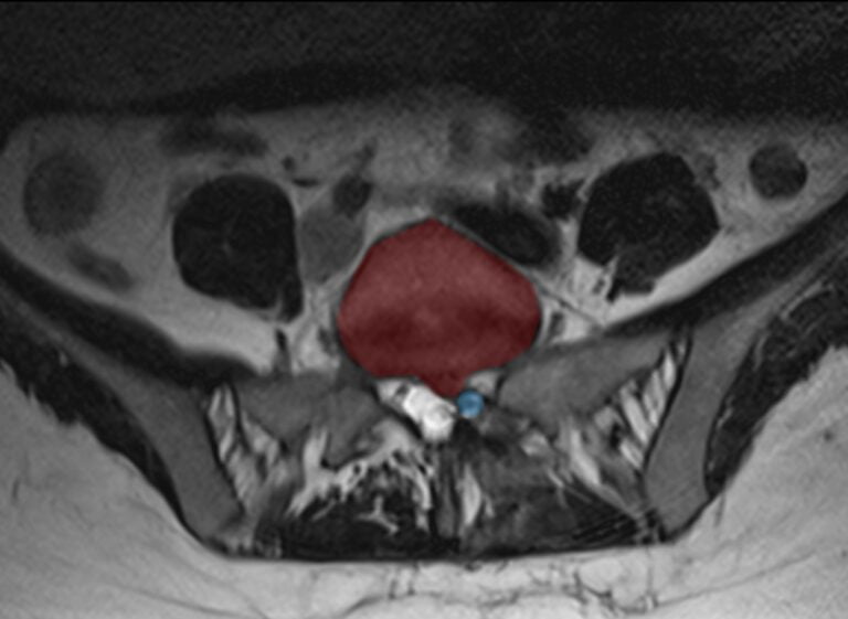 Hernie discale lombaire - Neurochirurgie Pitié Salpêtrière AP-HP