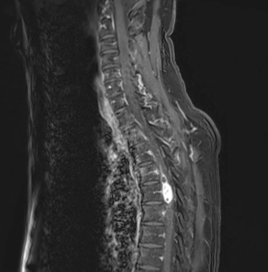 Neurochirurgie de la moelle épinière 3 Hemangioblastome medullaire