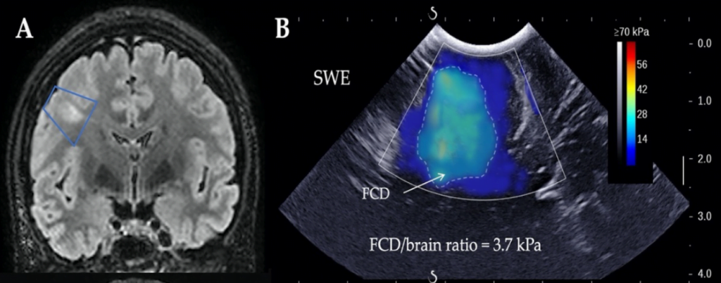 Chirurgie de l’Épilepsie 3 Lesion responsable d epilepsie