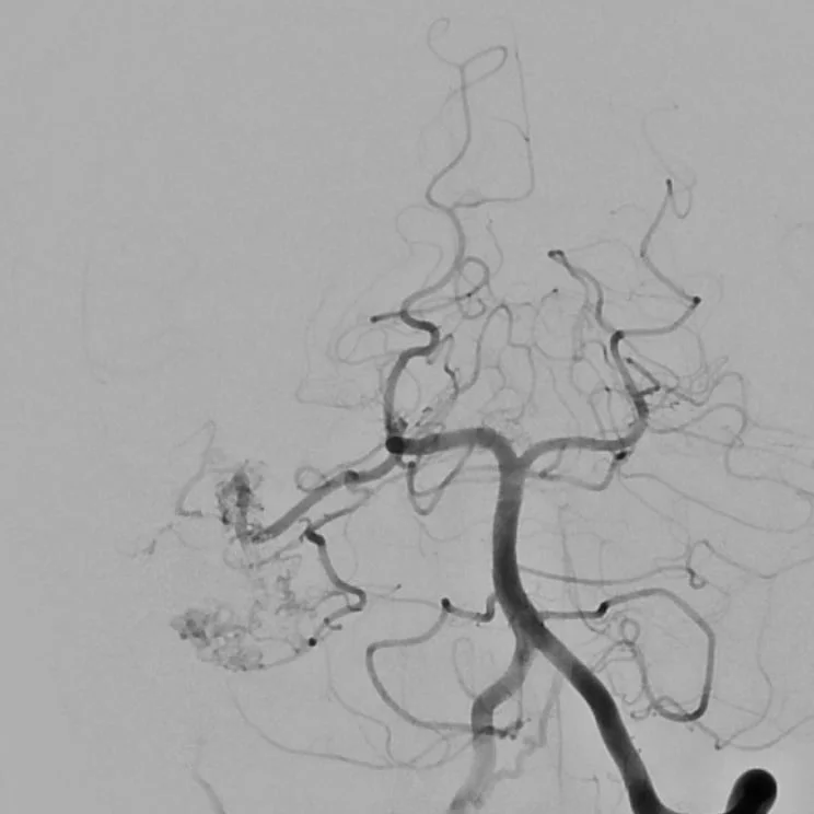 MAV Arterio Post