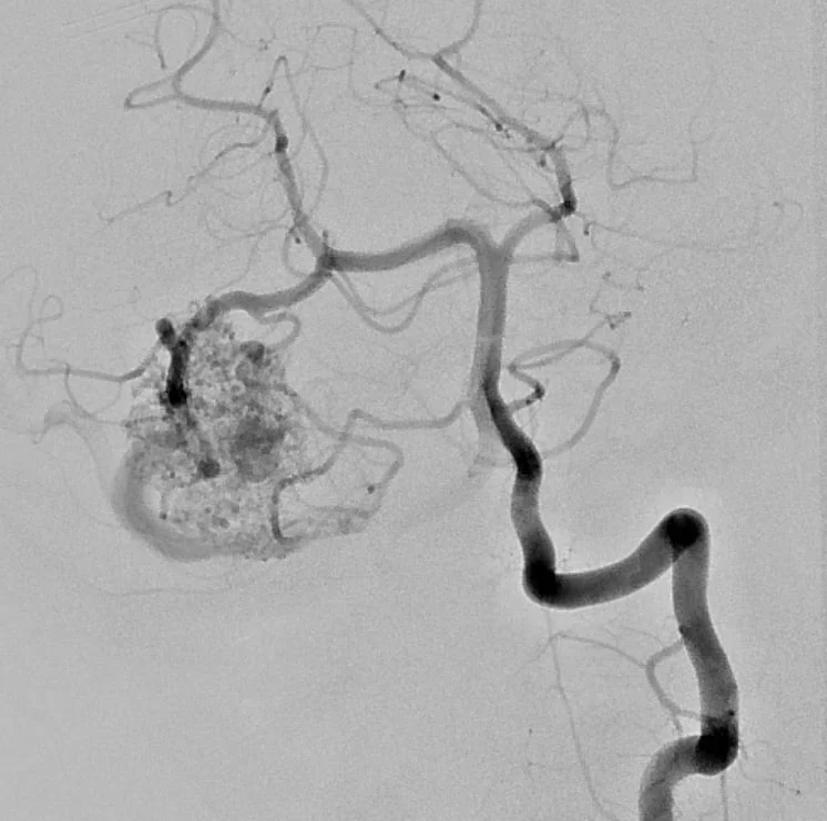 MAV Arterio Pre