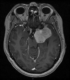 Les Méningiomes 6 Meningiome clinoidien