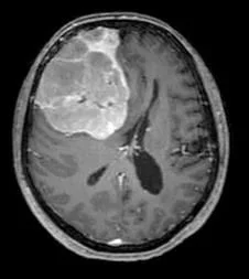 Les Méningiomes 3 Meningiome de la convexite frontal