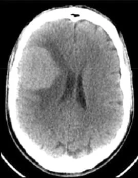 Les Méningiomes 1 Meningiome frontal gauche au scanner