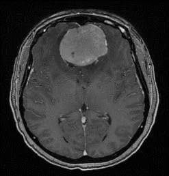 Les Méningiomes 7 Meningiome olfactif