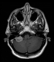 Les Méningiomes 8 Meningiomes de l angle ponto
