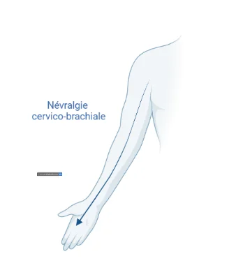 Nevralgie cervico brachiale