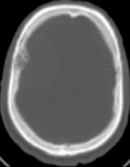 Les Méningiomes 2 epaississement de l os frontal en regard du meningiome