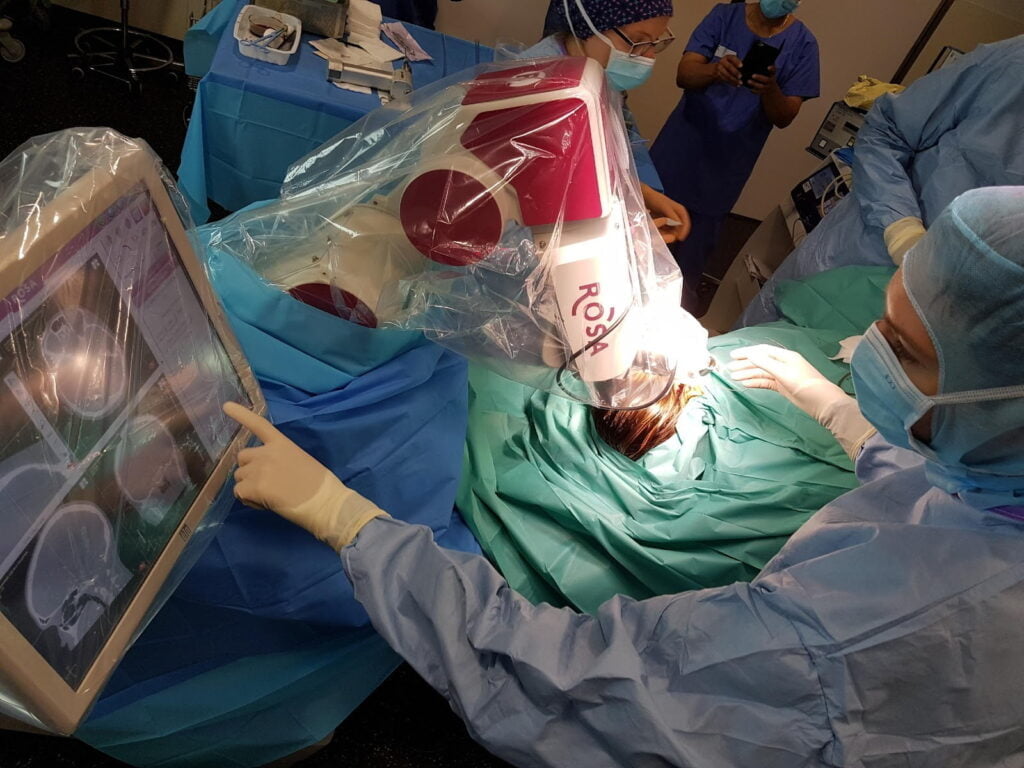Chirurgie de l’Épilepsie 1 implantation d electrodes de SEEG assistee par le robot ROSA